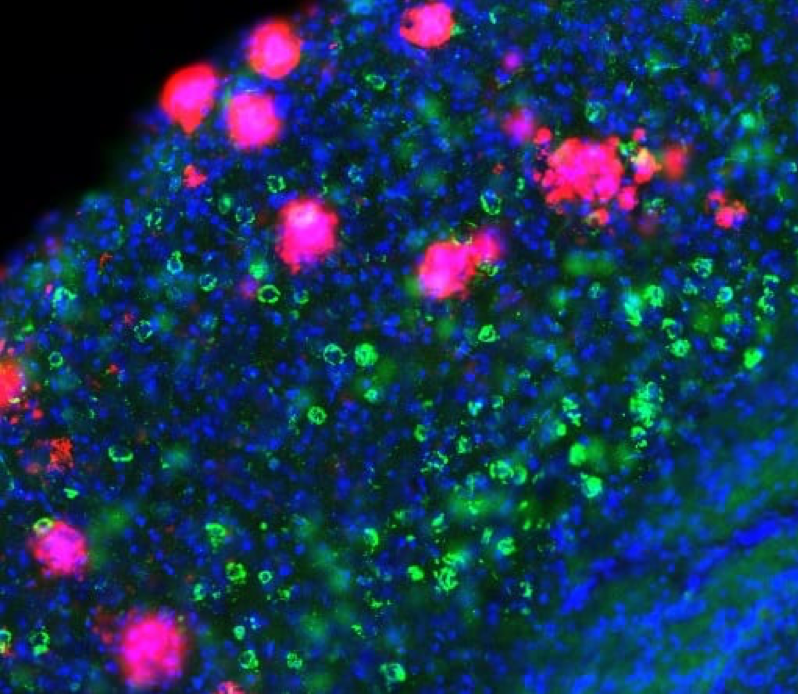 Photo shows a slice of brain tissue of a mouse engineered to have a condition akin to Alzheimer’s disease. Abnormal bits of amyloid-β protein are pictured; these glom onto each other, forming the plaques that are a hallmark of the disease. Also shown are tangles of tau protein, which gradually dominate as the disease progresses. 