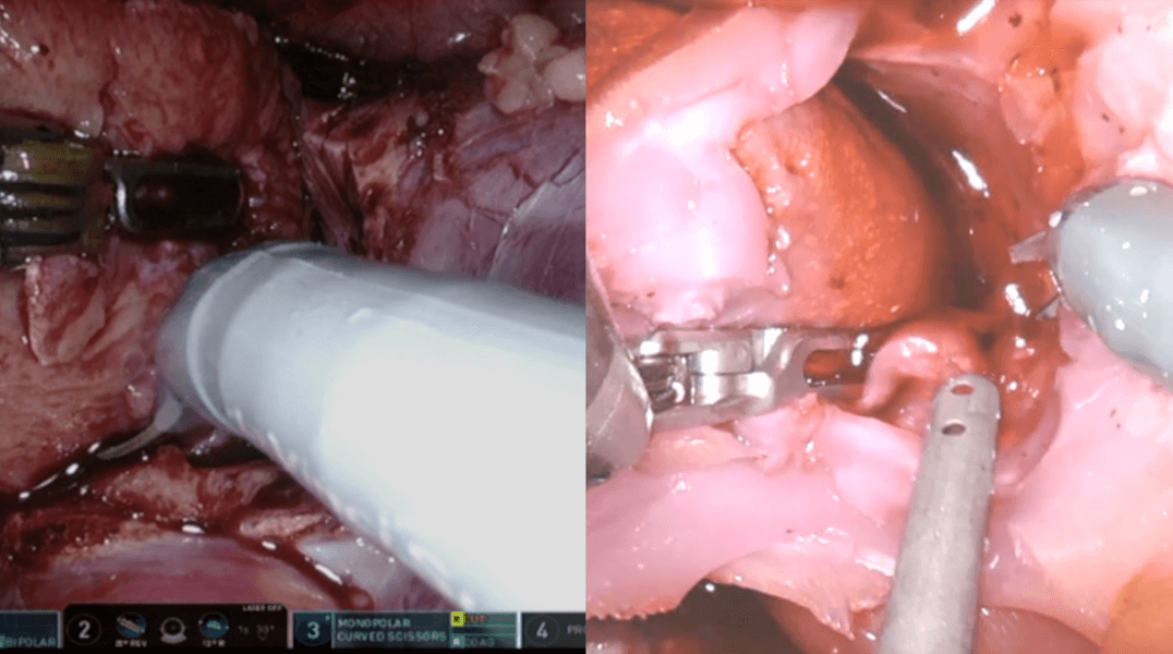 Photograph of an operation on a kidney model shown next to a real operation to cut out a tumor. The model oozes bloodlike fluid, to better simulate conditions during a real surgery.