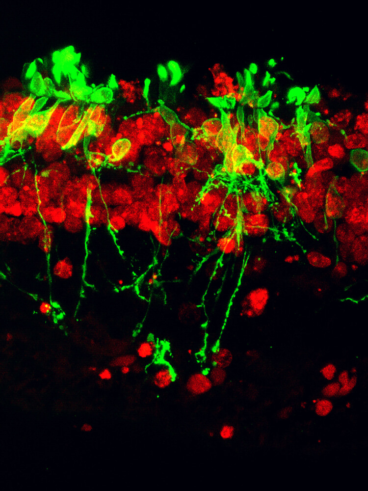 Confocal micrograph with fluorescent dyes shows disorganization of photoreceptor cells in retina in a patient with retinitis pigmentosa.