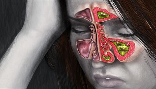 An illustration of a woman's inflamed sinuses.