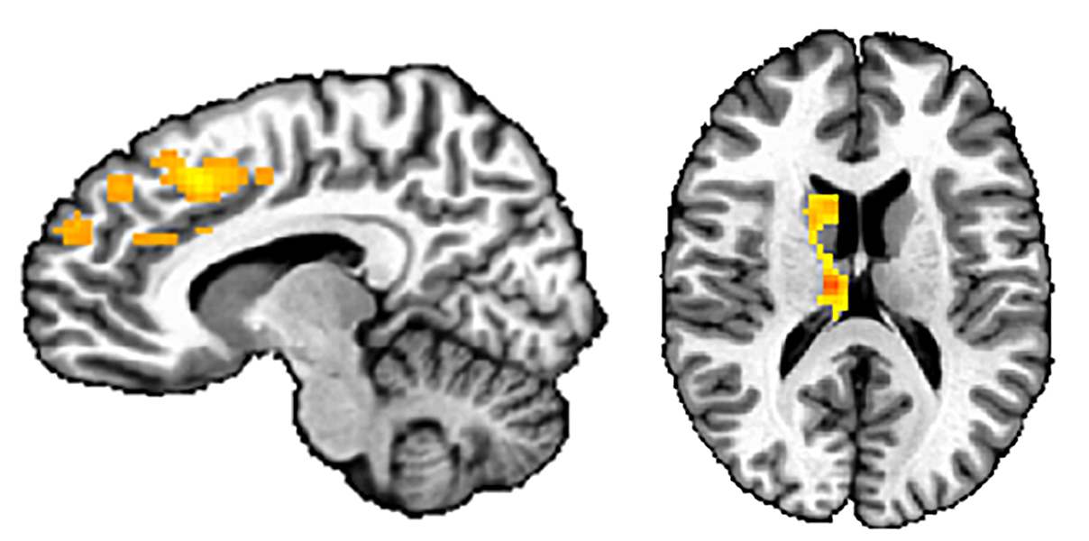 Images from fMRI studies showing two views of the brain, as a vertical “slice” viewed from the side and as a horizontal slice. Active parts of the brain are lit up in yellow and red.