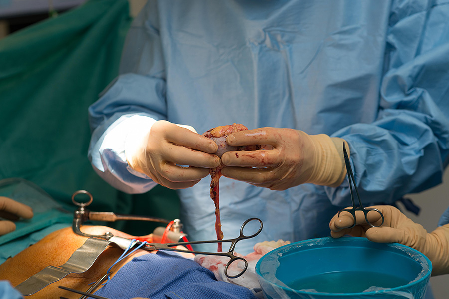 Photograph of a kidney transplant operation, with surgeon in blue gown and gloves holding a kidney above an open body cavity, with various metal clamps visible.